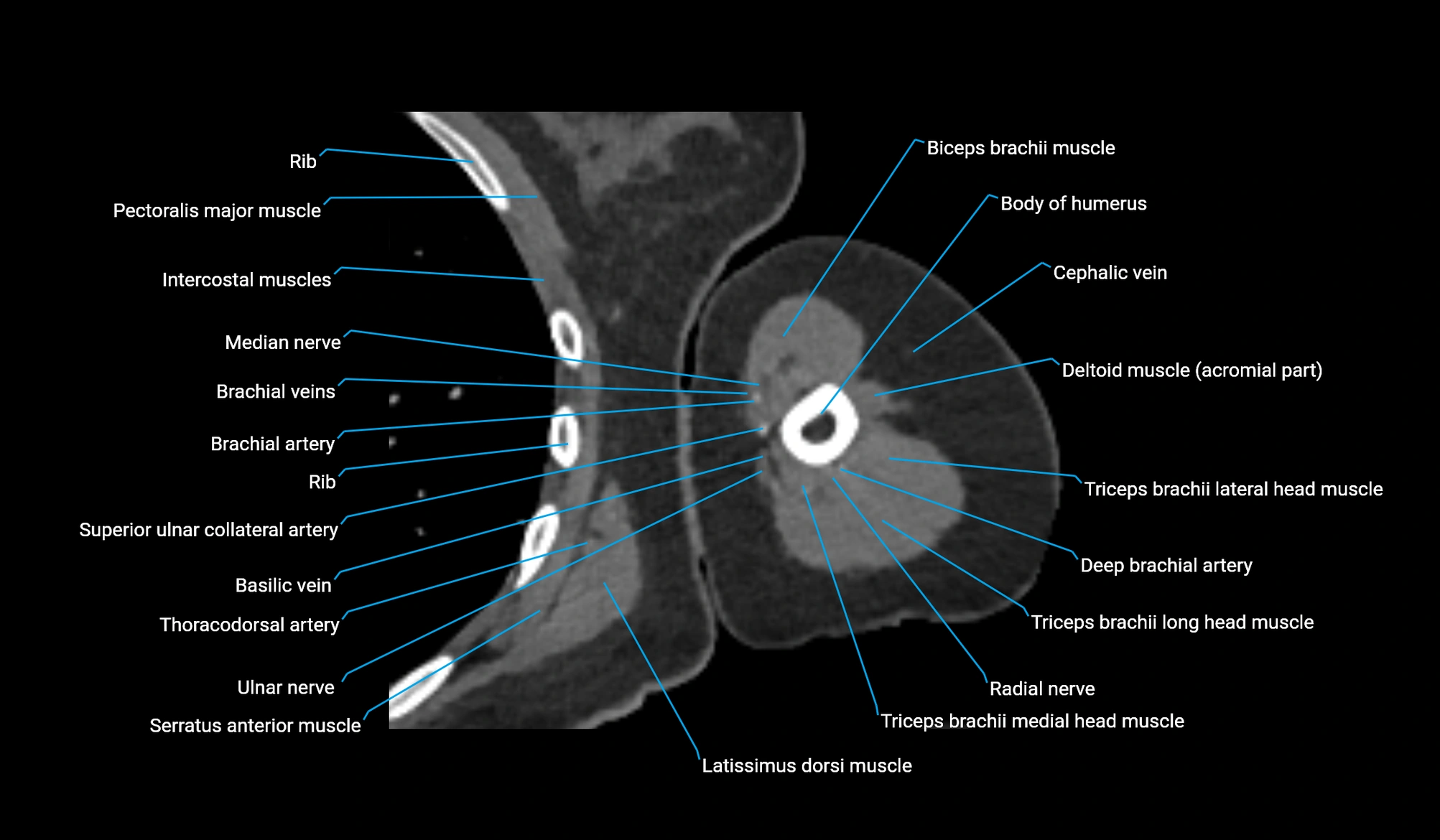 CT upper arm axial  cross sectional anatomy labelled radiology image -00220.webp